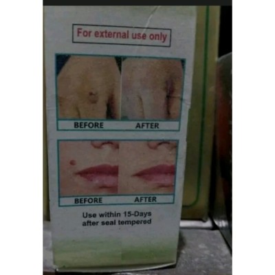 محلول زگیل عالی